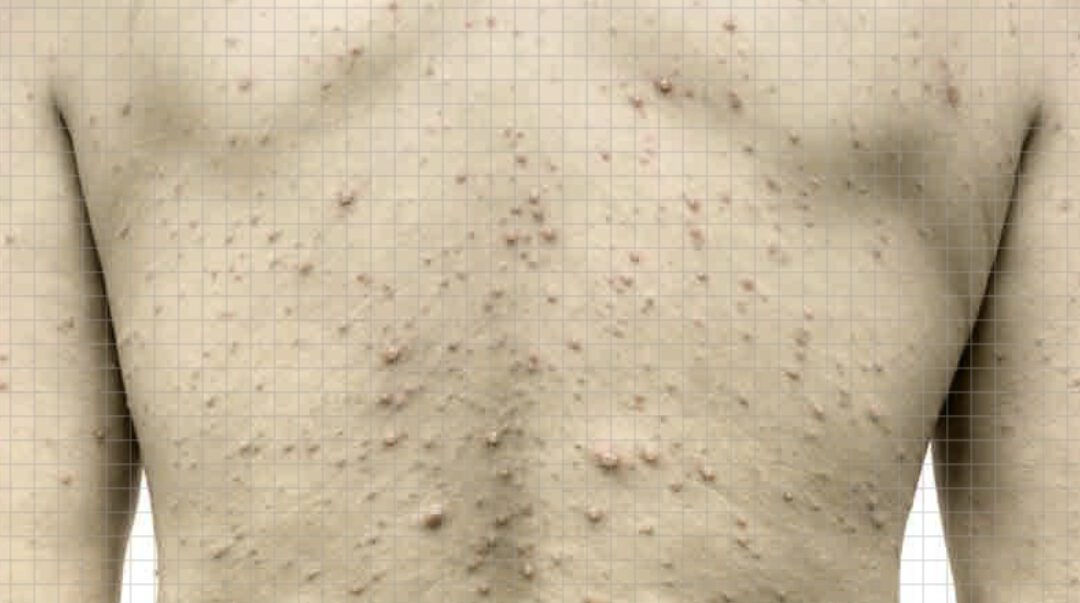 Chickenpox cases surge in Rohingya camps, not measles; over 8,000 infected in three months